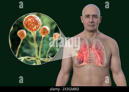 Illustration eines Mannes mit Lungenmukormykoseläsion und Nahaufnahme von Mucor-Pilzen, einem der Atiologen der Lungenmukormykose. Stockfoto