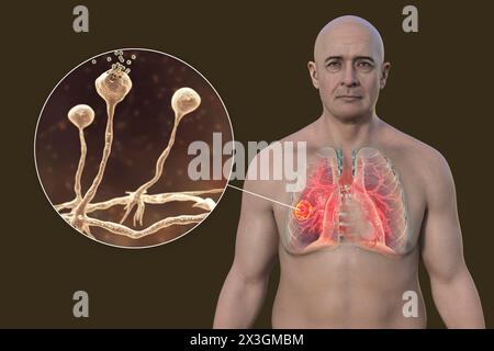Illustration eines Mannes mit Lungenmukormykoseläsion und Nahaufnahme von Rhizopuspilzen, einem der Atiologen der Lungenmukormykose. Stockfoto
