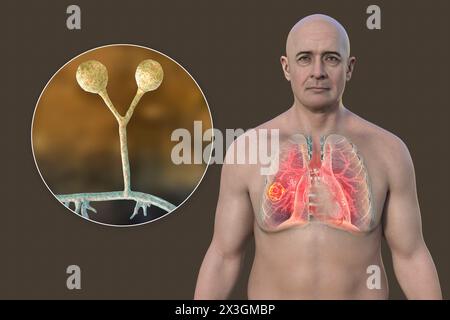Illustration eines Mannes mit Lungenmukormykoseläsion und Nahaufnahme von Rhizomucor-Pilzen, einem der Atiologen der Lungenmukormykose. Stockfoto