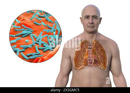 Illustration eines Mannes mit Lungen von Miliartuberkulose und Nahaufnahme von Mycobacterium tuberculosis-Bakterien. Stockfoto