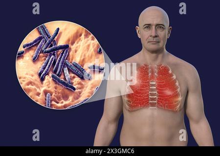 Illustration eines Mannes mit Lungen von Miliartuberkulose und Nahaufnahme von Mycobacterium tuberculosis-Bakterien. Stockfoto