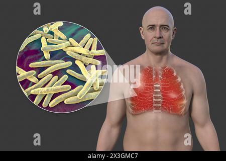 Illustration eines Mannes mit Lungen von Miliartuberkulose und Nahaufnahme von Mycobacterium tuberculosis-Bakterien. Stockfoto