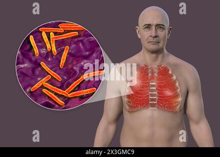 Illustration eines Mannes mit Lungen von Miliartuberkulose und Nahaufnahme von Mycobacterium tuberculosis-Bakterien. Stockfoto