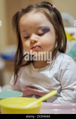 Kleines Mädchen mit Prellung oder Hämatom-Symptom im Gesicht nach Unfall stehen am Tisch Stockfoto