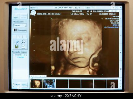 3D geburtshilflicher Ultraschall eines Fetus, 4D Baby Scan zeigt Bewegung, Gynäkologie, Krankenhaus Policlinica Gipuzkoa, San Sebastian, Donostia, Euskadi, Spanien Stockfoto