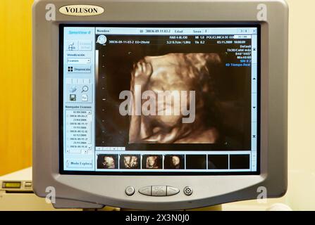 3D geburtshilflicher Ultraschall eines Fetus, 4D Baby Scan zeigt Bewegung, Gynäkologie, Krankenhaus Policlinica Gipuzkoa, San Sebastian, Donostia, Euskadi, Spanien Stockfoto