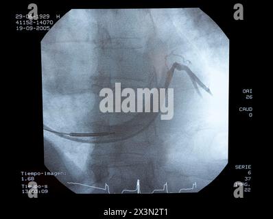 Angiographie, Implantation von ICD (Automatic Implantierbare Cardioverter Defibrillator), interventionelle und vaskuläre Radiologie, Hämodynamik. Krankenhaus Uni Stockfoto