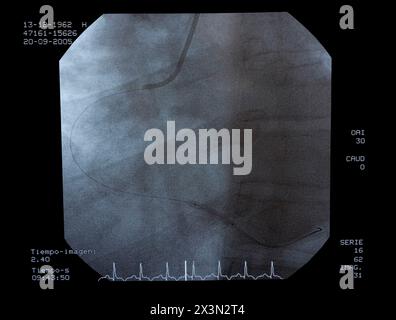 Angiographie, Implantation von ICD (Automatic Implantierbare Cardioverter Defibrillator), interventionelle und vaskuläre Radiologie, Hämodynamik. Krankenhaus Uni Stockfoto