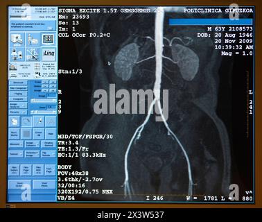 Nieren, Aorta, Nieren- und Beckenarterien, MRT (Magnetresonanztomographie), medizinische Bildgebung zur Diagnose. Krankenhaus Policlinica Gipuzkoa, San Sebastia Stockfoto