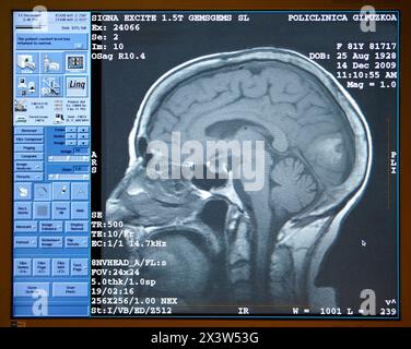 Hirntumor, MRT (Magnetresonanztomographie), medizinische Bildgebung zur Diagnose. Krankenhaus Policlinica Gipuzkoa, San Sebastian, Donostia, Euskadi, Spanien Stockfoto