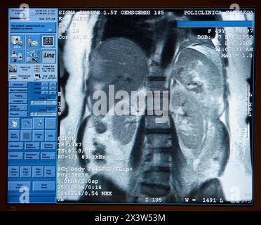 Abdomen: Leber, Milz, Nieren und Wirbelsäule, MRT (Magnetresonanztomographie), medizinische Bildgebung zur Diagnose. Krankenhaus Policlinica Gipuzkoa, San Sebasti Stockfoto