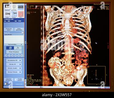 Aorta Arteria, Rippenkäfig, CAT-Scan (computergestützte Axialtomographie), Radiologie, medizinische Bildgebung zur Diagnose. Krankenhaus Policlinica Gipuzkoa, San Sebasti Stockfoto