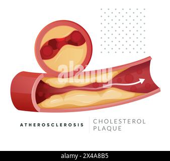 Atherosklerose – Plaquebildung – Stock-Illustration als EPS 10-Datei Stock Vektor