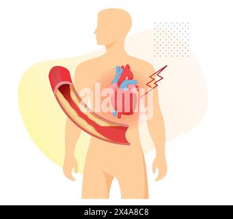 Atherosklerosestadien - Cholesterinplaque-Ansammlung im Herzen - Stock Illustration als EPS 10 Datei Stock Vektor