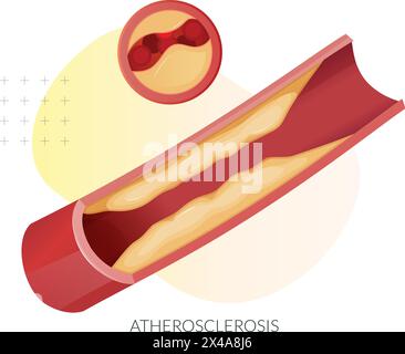 Atherosklerose – Plaquebildung – Stock-Illustration als EPS 10-Datei Stock Vektor