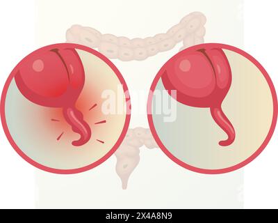Anhang – entzündeter Anhang – Stock Illustration als EPS 10-Datei Stock Vektor