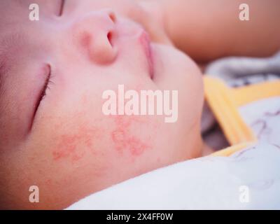 Neugeborenes mit Dermatitisallergie im Gesicht Stockfoto