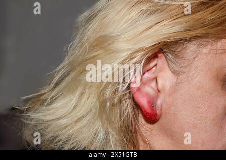 Entzündetes und blutiges Ohrläppchen nach Ohrpiercing Stockfoto