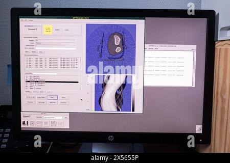 Toulouse, Frankreich. 30. Mai 2023. © Olivier Donnars/Le Pictorium/MAXPPP - Toulouse 30/05/2023 Olivier Donnars/Le Pictorium - 30/05/2023 - France/Toulouse - Scanner de la densite osseuse de l'avant-bras d'Erwan, 21 ans, le plus jeune des volontaires. - Valeurs ACtuelles out, no jdd, jdd out, RUSSIA OUT, NO RUSSIA OUT #norussia/30/05/2023 - France/Toulouse - Knochendichtescan des Unterarms von Erwan, 21, dem jüngsten Freiwilligen. Quelle: MAXPPP/Alamy Live News Stockfoto