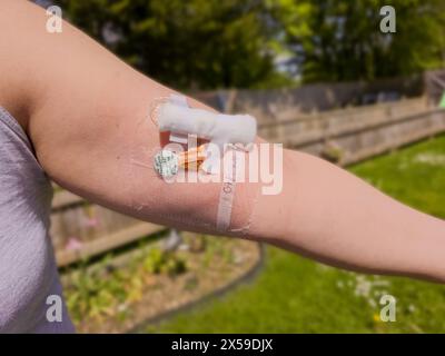 Eine Frau zeigt ihre PICC-Linie in den Oberarm eingeführt Stockfoto