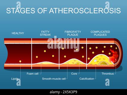 Stadien der Atherosklerose von Lipiden in Blutfluss und Fettstreifenablagerung im Endothel, zur fibrofettigen Plaquebildung, Plaquebildung, Calci Stock Vektor