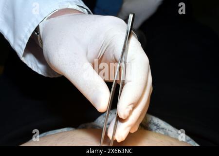 Nahaufnahme der Hand eines Arztes in einem Gummihandschuh, mit der er eine Pinzette hält. Stockfoto