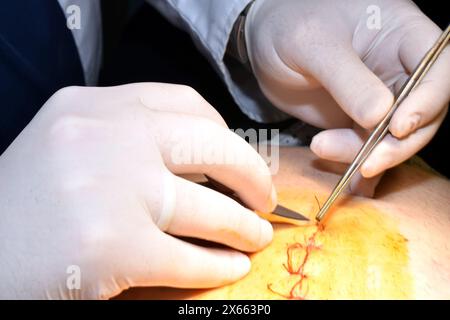 Die Hände eines Chirurgen, der mit einer Pinzette und einem Skalpell Fäden aus einer Naht am Magen des Patienten entfernt. Stockfoto