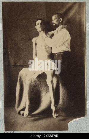 Nicht identifizierter ausgemerderter Kriegsgefangener, entlassen aus dem Gefängnis in Belle Isle, Richmond, im U.S. General Hospital, Div 1, Annapolis, Bürgerkriegsfotos 1861-1865 Stockfoto