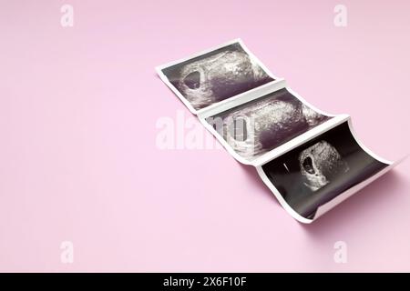 Ultraschallbild, Bild Von 7 Wochen Schwangere Frau Mit Zwillingen, Embryo Auf Rosa Hintergrund. Selektiver Fokus. Platz Für Text, Modell. Fetusentwicklung Stockfoto