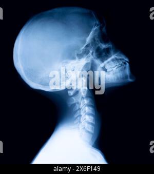Film Röntgen Schädel und Halswirbelsäule Seitenansicht Stockfoto