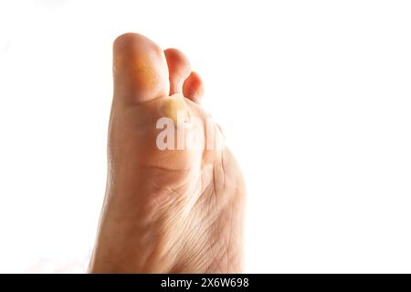 Fuß mit trockener Haut an Ferse und Sohle. Männliche Füße, mit rauer und rissiger Haut isoliert auf weißem Hintergrund, Nahaufnahme, Kopierraumbild für medizinische Zwecke. Stockfoto