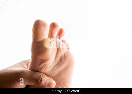 Fuß mit Kallus, Haut löst sich vom Fußboden ab Stockfoto