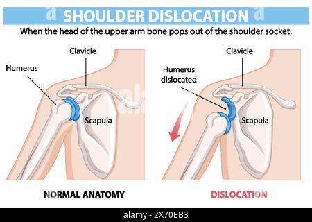 Vergleich normaler und luxationaler Schulteranatomie Stock Vektor