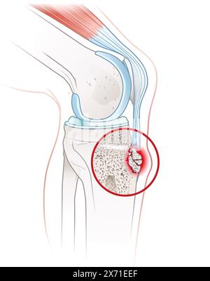 Morbus Osgood-Schlatter verursacht Knieschmerzen und Schwellungen an der Tuberosität der Unterschenkel, häufig bei Jugendlichen aufgrund des schnellen Wachstums und der körperlichen Aktivität. Stockfoto