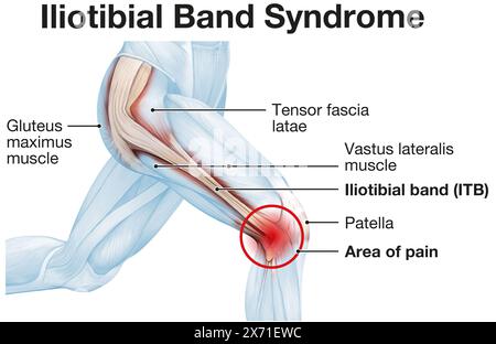 Iliotibiales Bandsyndrom: Kniebeschwerden, die Schmerzen an der Außenseite des Knies aufgrund einer Entzündung oder Überbeanspruchung verursachen Stockfoto