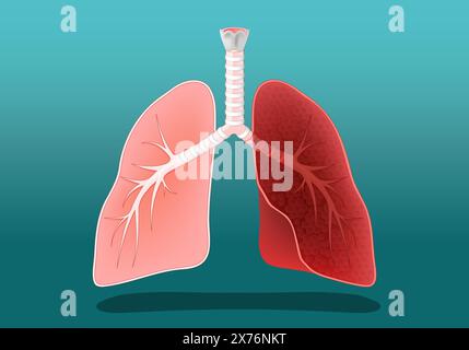 Die menschliche Lunge. Gesund und krank, entzündet oder wie Lungen eines Rauchers oder einer Person mit Krebs. Vektorposter. Abbildung „Isometrische Abwicklung“. Stock Vektor