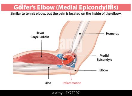 Detaildiagramm der medialen Epicondylitis im Ellenbogen Stock Vektor