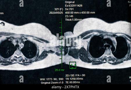 Magnetcomputertomographisches Foto von Frauen Stockfoto