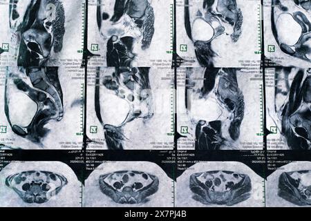 Magnetcomputertomographisches Foto von Frauen Stockfoto