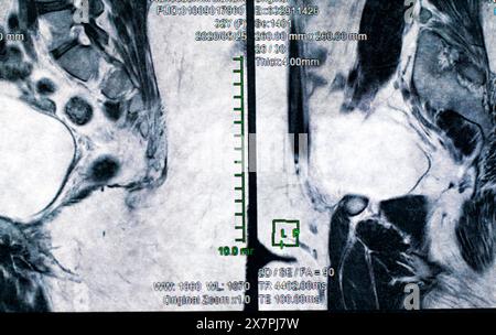Magnetcomputertomographisches Foto von Frauen Stockfoto