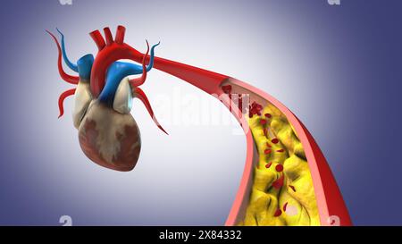 Cholesterinplaque in der durchblutungsblockierenden Arterie Stockfoto