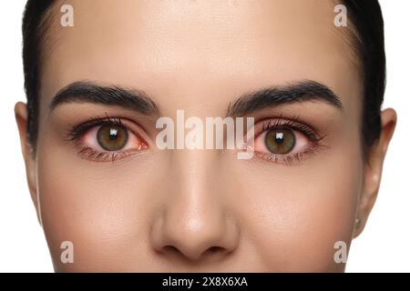 Frau mit roten Augen, die an Bindehautentzündung auf weißem Hintergrund leidet, Nahaufnahme Stockfoto