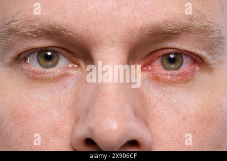 Mann mit rotem Auge, der an Bindehautentzündung leidet, Nahaufnahme Stockfoto