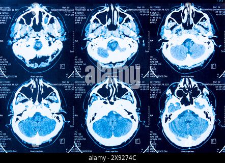 Tomographie des Gehirns mittels Scanner. Hirnscan 013843 019 Stockfoto