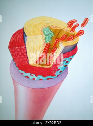 Wenn sich ein Blutgerinnsel in einem Blutgefäß bildet, verschließt es die Arterie oder Vene und verursacht Thrombosen. Hier ist eine arterielle Thrombus-Blutgerinnsel-ARTERIELLE THROMBOSE dargestellt, ZEICHNUNG 001366 005 Stockfoto