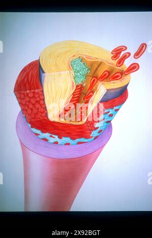 Die Bildung von Blutgerinnseln in einem Gefäß blockiert die Arterien oder Venen und verursacht eine Thrombose. Hier ist das arterielle Thrombus-Blutgerinnsel. ARTERIELLE THROMBOSE, ZEICHNUNG 001366 004 Stockfoto