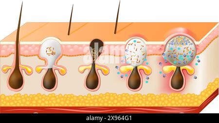 Arten der Aknepickel. Weißköpfe, Mitesser, Papeln und Pusteln. Querschnitt menschlicher Hautschichten. Nahaufnahme einer Talgdrüse mit Sebum Stock Vektor