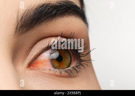 Frau mit rotem Auge, die an Bindehautentzündung auf weißem Hintergrund leidet, Nahaufnahme Stockfoto