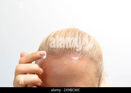 Cropped Female trägt Feuchtigkeitscreme auf, Creme auf Sonnenbrand auf der Kopfhaut, Stirn unter dem Haar. Weißer Hintergrund. Sonnenerythem. Weiße Frau Leidet Darunter Stockfoto