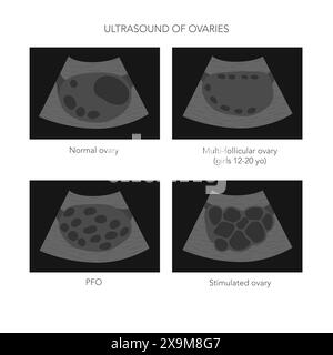 Medizinische Vektordarstellung der Ovarialsonographie mit normalen, polyzystischen und stimulierten Ovarialbildern. Stock Vektor